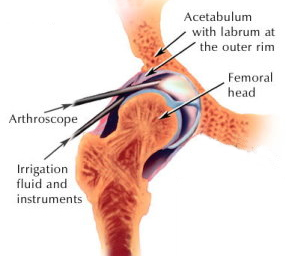 Hiparthroscopy